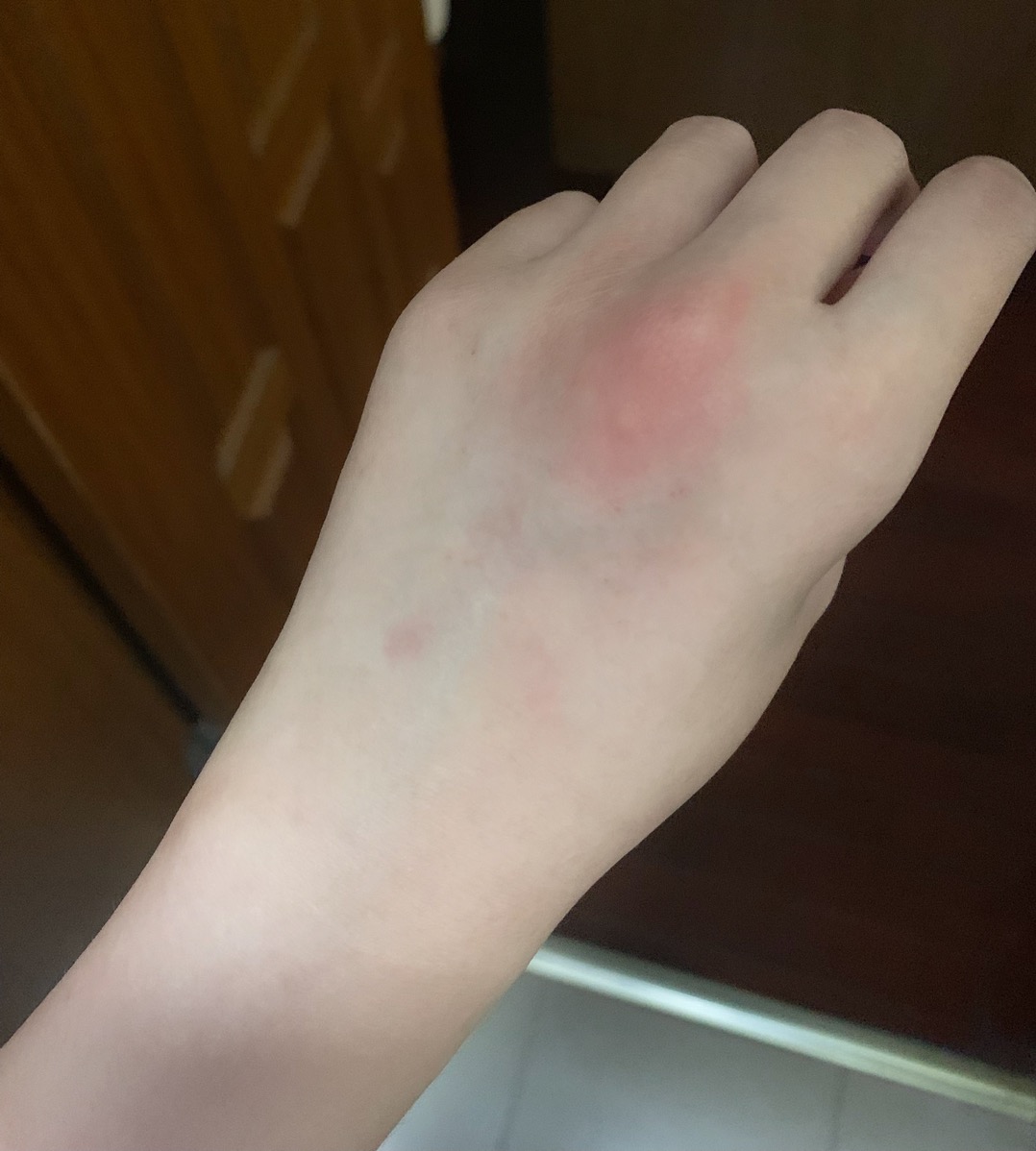 你问我为什么不谈恋爱,女人真麻烦,我讨厌的荨麻疹,体弱多病,药罐子 你问我为什么不谈恋爱,女人真麻烦,我讨厌的荨麻疹,体弱多病,药罐子