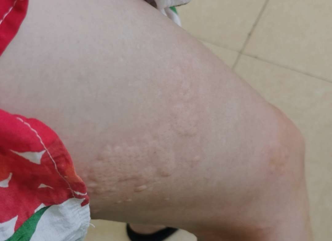 过敏了,我讨厌的荨麻疹 过敏了,我讨厌的荨麻疹