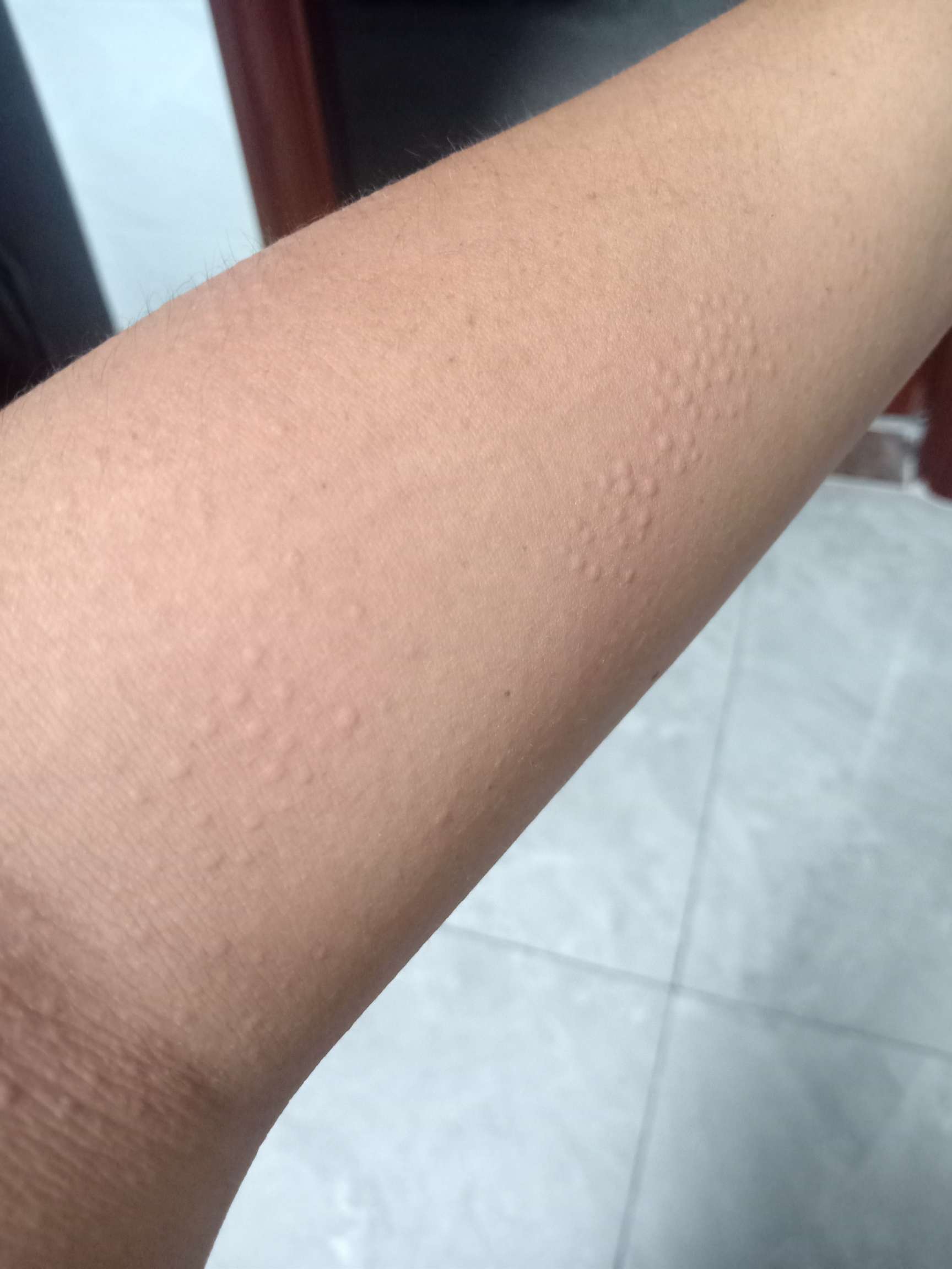 我讨厌的荨麻疹 我讨厌的荨麻疹